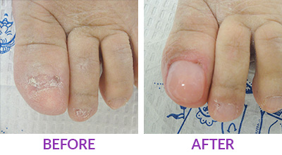 keryflex nail restoration before and after photo