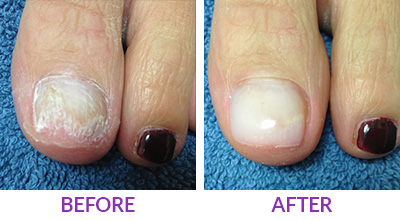 keryflex nail restoration before and after photo