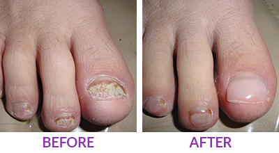 keryflex nail restoration before and after photo