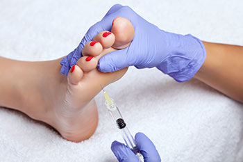 botox for hyperhidrosis