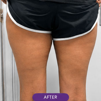 cellulite 01 after