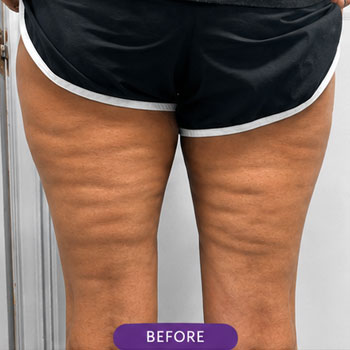 cellulite 01 before