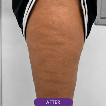cellulite 02 after