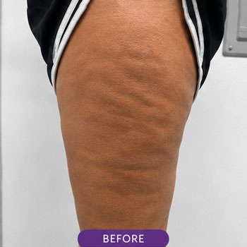 cellulite 02 before