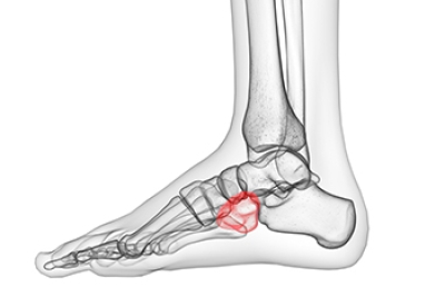 Understanding Cuboid Syndrome and Its Effects