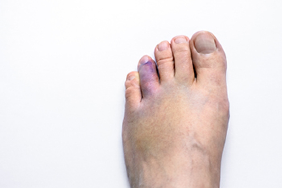 Broken toe warning signs