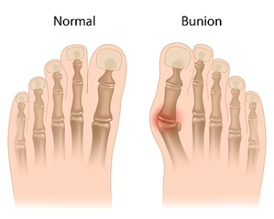 Understanding Bunions and Their Risk Factors